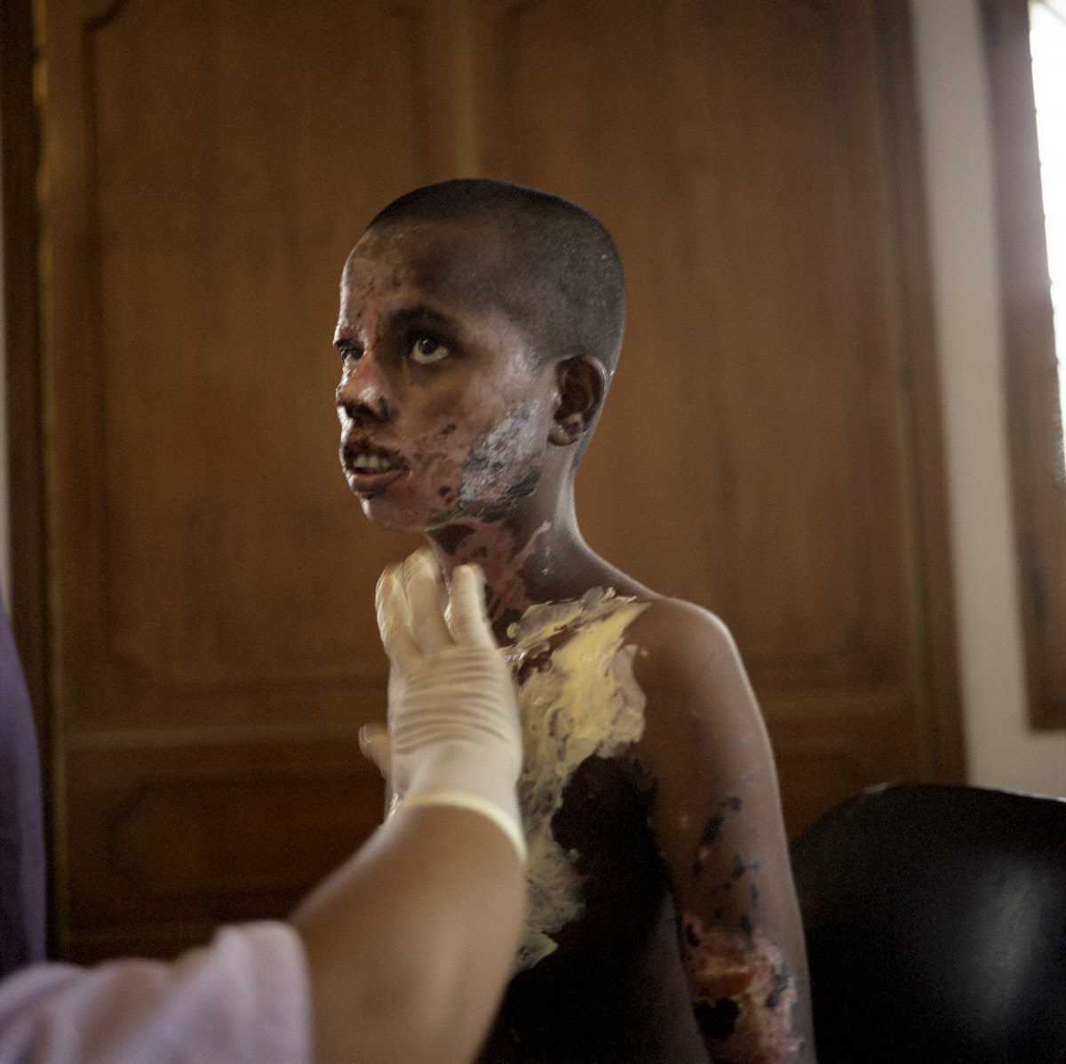 Acid attacks in Bangladesh