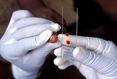 Malaria research: taking blood samples.