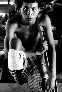 Landmine victim in the military hospital of Siem Reap.