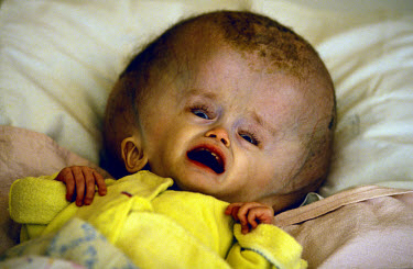 Abandoned child in the orphanage in Semipalatinsk, suffering from hydrocephalus (water on the brain). There have been three cases locally in recent years, and doctors maintain that it is one of the ge...