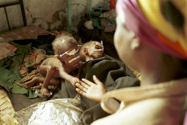 A mother with her severely malnourished children at a Medecins Sans Frontieres (MSF) therapeutic feeding centre. The military strategies of the government armed forces and UNITA rebels toward the civi...