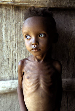 4 year old Amarech Gujo is severely malnourished. Her father, Gujo Guto, was so desperate for money that he dismantled the family home, sold it off for scrap and moved the family into his mother's hou...