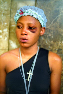 Jessica, who works as a sex worker and is from Nigeria, after being beaten up the night before. She did not specify by whom, but everything indicates that she was beaten by a customer. She and other s...