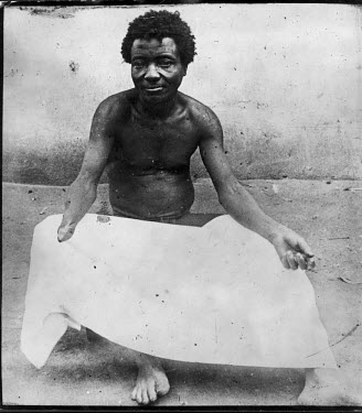 Isekausu whose hand was chopped off  by Ikombi, one of the rubber concession's sentries.   The Belgian Congo under King Leopold II employed mass forced labour of the indigenous population to extract r...