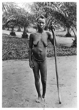 Girl with amputated foot, mutilated by sentries from a rubber concession.   The Belgian Congo under King Leopold II employed mass forced labour of the indigenous population to extract rubber from the...