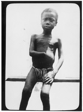 A young boy with a severed hand, mutilated by Congolese militias after his father failed to meet his rubber quota.   The Belgian Congo under King Leopold II employed mass forced labour of the indigeno...