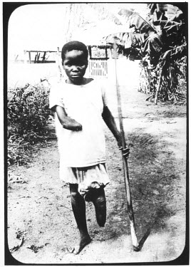 A young boy (Impongi) with a severed hand and foot, mutilated by sentries after his village failed to meet its rubber quota. He was a witness before Leopold's Commission of Enquiry which was an unsucc...