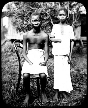 A young man and woman with severed arms.  Mola's hands, seated, were destroyed by gangrene after being tied too tightly by soldiers.  Yoka's hand, standing, was cut off by soldiers wanting to claim hi...