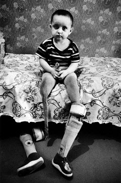 Markha, a child who lost her legs as an infant when her mother was killed protecting her from a rocket attack. Her legs, which stuck out behind her mother's body, were blown off.