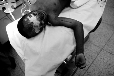 Nine year old George Francis lies in the operating theatre in the Disability Hospital CCBRT (Comprehensive Community Based Rehabilitation Tanzania). He fell into a fireplace when he was one year old....