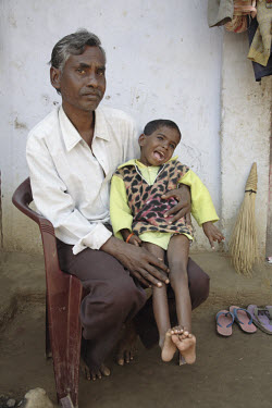 Adivasi child Guddia Das (7) cannot talk, walk or sit and will need constant care for the rest of her life. Her parents think the water from the village well was contaminated with radiation from the n...