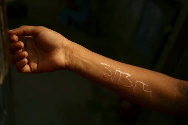A sex worker holds up her scarred arm. She bears these scars after attempting to engrave the name of her lover on her arm.