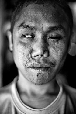 31 year old Pahgo: "I was in the KNLA (Karen National Liberation Army) and we were attacked by the Burmese army. We had to lay out landmines for protection. After the fighting, I started to remove the...