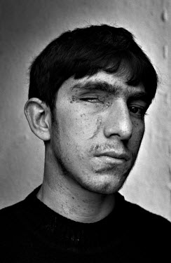 A Kurdish boy who was injured by a landmine. Eastern Turkey is blighted by landmines. During the 1950s, the cause was illegal border trading; in the 1990s, the cause was war with the PKK (Kurdistan Wo...