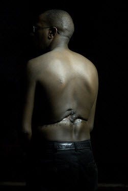 33 year old Marcel Rutagarama shows the injuries inflicted during the 1994 genocide.