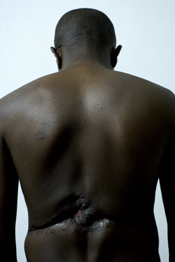 33 year old Marcel Rutagarama shows the injuries inflicted during the 1994 genocide.