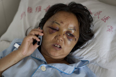 33 year old Ling Xiumer recovers in the Number 2 Hospital in Urumqi. She was beaten by a Uighur mob on July 5th. Ethnic violence between the Uighur and Han Chinese erupted in the city a few days earli...