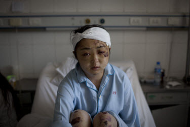 24 year old Dong Yuanyuan recovers in the Number 2 Hospital in Urumqi. She is an air stewardess teacher who was beaten up with her husband on a bus and left unconscious by a Uighur mob. She is now mea...