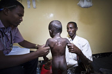 A nurse examines a malnourished child who has burns on his body caused by a traditional healer's treatment, given in belief that it could cure diarrhoea. The child's mother visited the healer prior to...