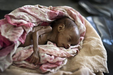 A severely malnourished child in Galcayo hospital. Galcayo is a town in the self-declared autonomous state of Puntland. The populace in the region suffers from a litany of problems including conflict,...