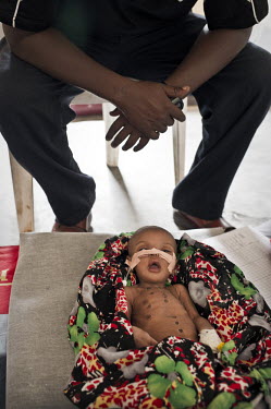 A nurse watches over a severely malnourished child in Galcayo hospital. The wounds to the child's body were caused by a traditional healer giving a treatment that was believed to be a cure for diarrho...