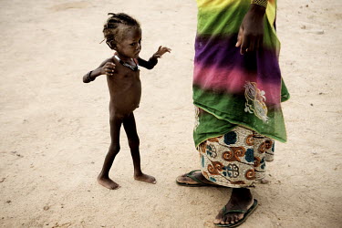 A mother and her child at a Medecins Sans Frontieres (MSF) centre for severely malnourished children.