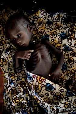 A severely malnourished child lies on a cloth at a Medecins Sans Frontieres (MSF) feeding centre.