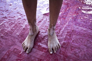 A person with injuries to their legs at an evacuation centre on the outskirts of Bangkok. Large parts of central and northeastern Thailand have been severely affected by the worst flooding for seventy...