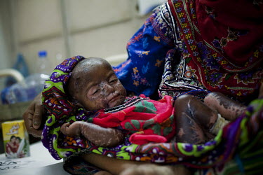 A mother holds her child who is suffering from severe dermatitis brought on by malnourishment, in the nutrition stabilisation centre in Hyderabad Civil Hospital. Acute respiratory illnesses and skin d...