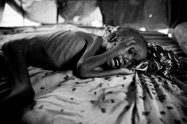 A three year old girl, who has severe malnutrition, lies naked, on the floor of a makeshift tent in a camp for IDPs (internally displaced persons). The Horn of Africa is currently suffering the worst...