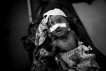 A malnourished child, being treated in Banadir Hospital, attached to a feeding tube. The Horn of Africa is currently suffering the worst famine in 60 years and a s a result people have been streaming...