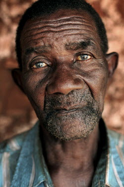 Oswald Ndabashima (79) has Onchocerchiasis. Cibitoke is one of four provinces in Burundi that are severly affected by Neglected Tropical Diseases such as Onchocerchiasis (River Blindness), Schistosomi...