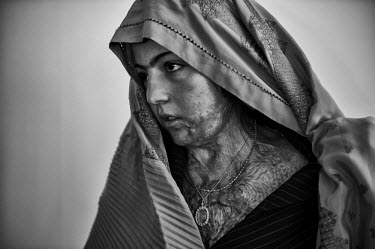 Vaseyeh, who self-immolated in 2008, shows her burn scars at a hostel which provides training in vocational skills. The hostel is run by the Association for Cooperation with Afghanistan (ACAF). Severa...