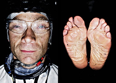Rune Jarwson and his feet after he has finished the bike race The Big Trial of Strength, stretching 540km from Trondheim to Oslo.