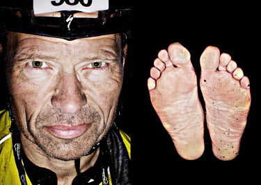 Eirik Normann and his feet after he has finished the bike race The Big Trial of Strength, stretching 540km from Trondheim to Oslo.