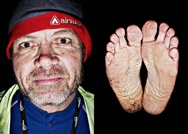 Jan Ove Skilbrei and his feet after he has finished the bike race The Big Trial of Strength, stretching 540km from Trondheim to Oslo.