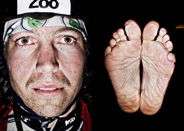 Rickard Perman and his feet after he has finished the bike race The Big Trial of Strength, stretching 540km from Trondheim to Oslo.