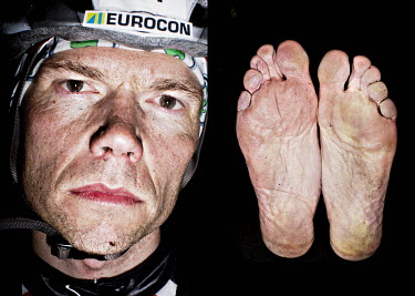 Jorgen Nylen and his feet after he has finished the bike race The Big Trial of Strength, stretching 540km from Trondheim to Oslo.