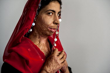 Zahra, who set herself on fire in 2006, shows her burn scars at a hostel which provides training in vocational skills in Herat. The hostel is run by the Association for Cooperation with Afghanistan (A...