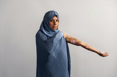 Latifeh, who allegedly set herself on fire due to family violence in year 2004, shows her burn scars at a hostel which provides training in vocational skills in Herat. The hostel is run by the Associa...