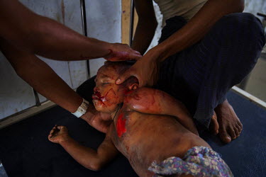 A relative holds the head of the unconscious Gulshan, a five year old Rohingya IDP who was knocked over by a motorbike minutes earlier, at the Ministry of Heath's 'Dapaing Emergency Hospital' in the R...