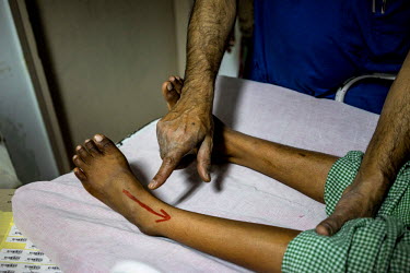 Dr. Mathew Varghese points to polio sufferer Parveen's feet prior to an operation at the St. Stephen's Hospital. Dr. Mathew Varghese is a polio specialist who is providing ground breaking technology a...