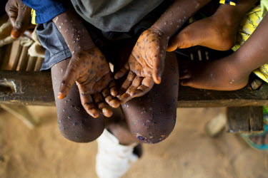 Children with lesions, one of the symptoms of Monkey Pox, during an outbreak in the north of the country. Monkeypox is a viral disease, related to smallpox. It can be transmitted from animals to human...