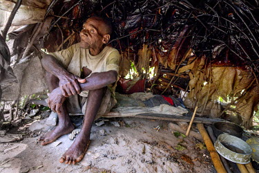 Mr Mackolia an elderly Baaka (pygmy) sits in his home. He thinks he is over ninety year old and is suffereing from sand fleas, or jiggers, which have left his feet swollen and infected. He cannot affo...