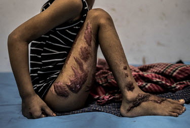 Nur Fatima (6) recovers in Sadar Hospital, after fleeing anti-Rohingya violence in Myanmar's Rakhine state. When soldiers fired a grenade into their house, setting it ablaze, Nur's father couldn't sav...