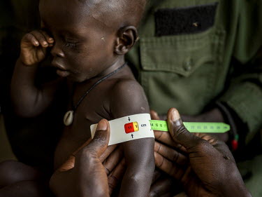 Athian, the son of Peter Ksamy Jsiu (31), a soldier from the national army, is checked by a doctor at the Al Sabbah Children's Hospital in Juba where children suffering from severe malnutrition are tr...