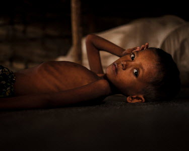 Sami Alter, 4.5 years old, from Maungdaw in Myanmar has been ill for 12 days. Unable to eat, she has  been diagnosed with SAM (Severe acute malnutrition).  Her family fled the violence in their region...
