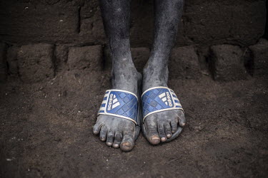 The feet of an eleven year old South Sudanese refugee in Bidibidi camp.