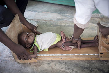 A malnourished child is measured at a rural health post.