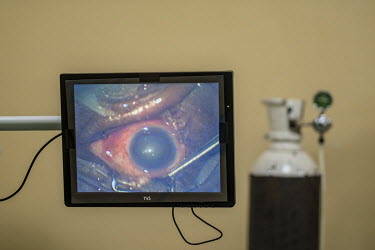 A monitor displays a live image of Aziza Daudo's eye during an operation to remove cataracts at the Nampula government hospital.